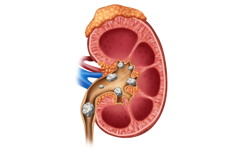 PCNL-kidney-stones